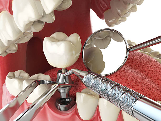 Best Emergency Dentist for Lost Fillings or Crowns in Grayling, MI